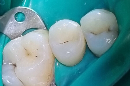 Примеры работ QR Dental