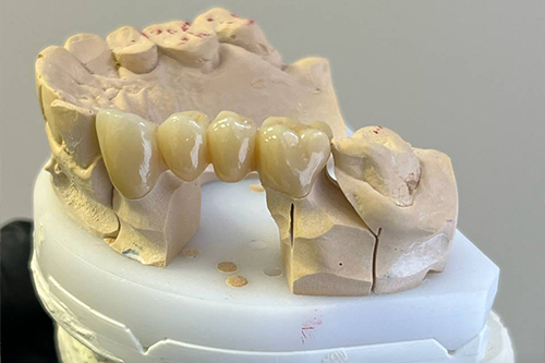 Срок службы зубного импланта