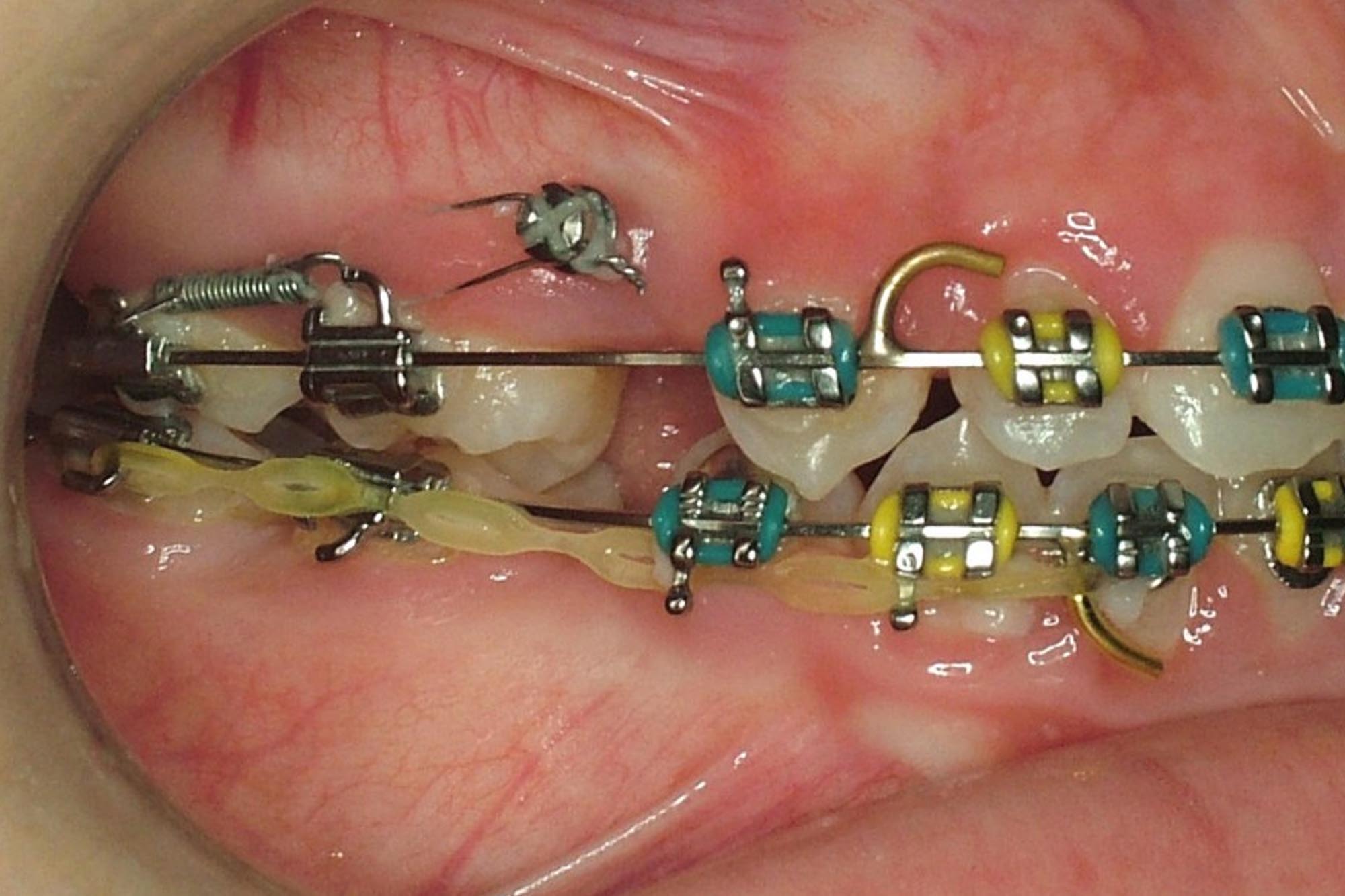Ортодонтические винты